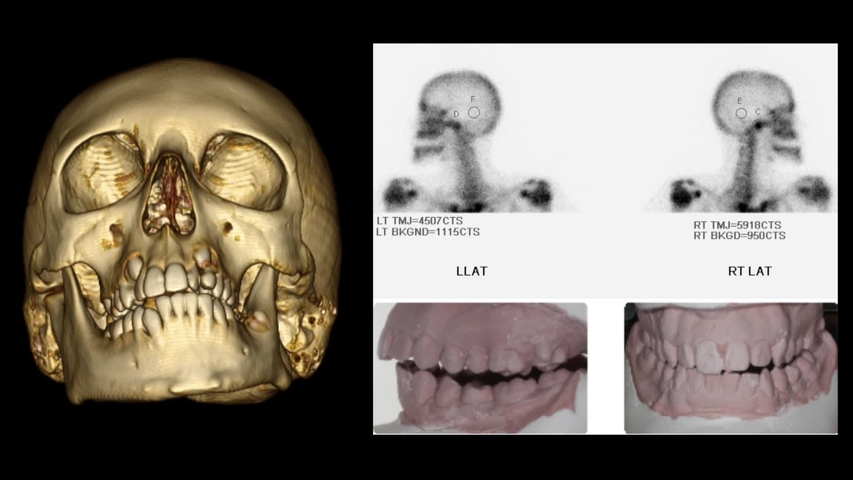 Component Facelift Approach To The Temporomandibular Joint