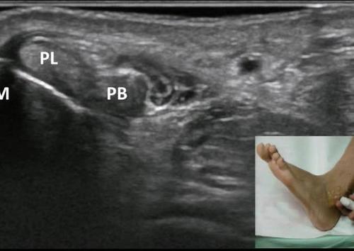 Dynamic ultrasound imaging for type A intrasheath subluxation of the peroneal tendons