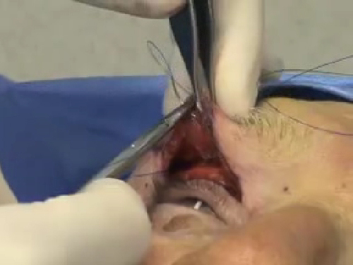 The Extended Transblepharoplasty Browplexy for Lateral Brow Ptosis