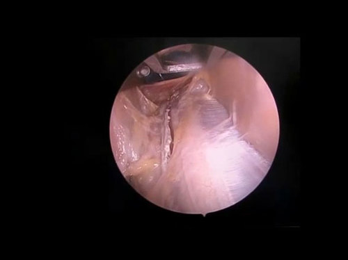 Endoscopic suturing