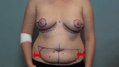 Where Are Incisions Made In A DIEP Flap Breast Reconstruction? - Ellsworth  Plastic Surgery