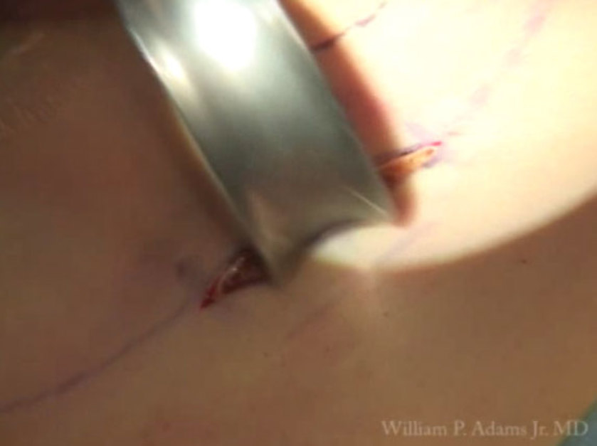 Breast Augmentation Archives - WILLIAM P. ADAMS JR., MD PLASTIC