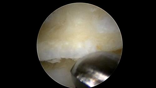 Calcaneal exostectomy during two medial incision plantar fascia endoscopy