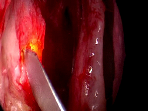 Endoscopic endonasal retrieval of silicone punctal plugs from the lacrimal sac 1