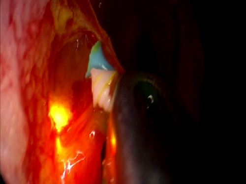 Endonasal endoscopic video of punctal plug retrieval from the lacrimal sac 2