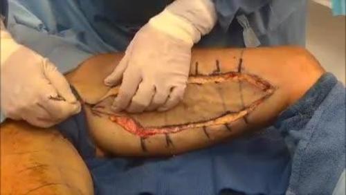 Vertical Thigh Lift using the Avulsion Thighplasty. From “Avulsion Thighplasty: Technique Overview and 6-Year Experience.” 137(1).