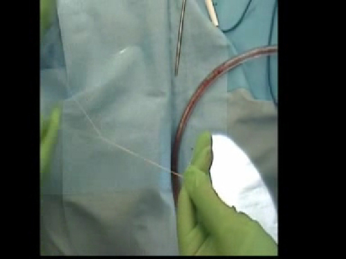 Nylon Foil Wraparound Repair of Combined Orbital Floor and Medial Wall Fractures
