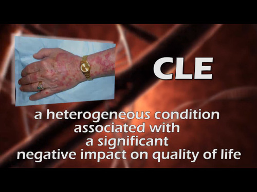25(5) – September 2013 – Update on pathogenesis and treatment of CLE