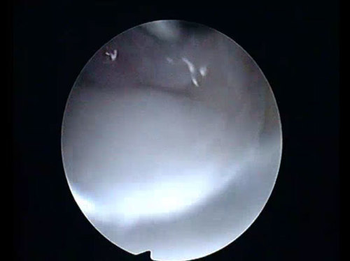 Palpation of the RSC (MC part) (Left wrist)