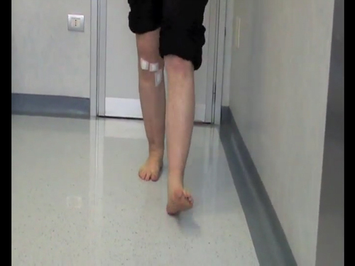 THE ANTERIOR TIBIALIS TENDON RE-ROUTING TECHNIQUE: CLINICAL RESULT 1