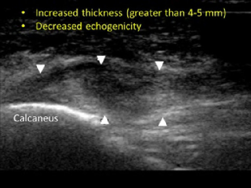 Ultrasound-Guided Diagnosis and Treatment of Plantar Fasciitis