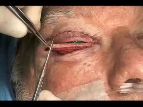 Eyelid surgery deals video