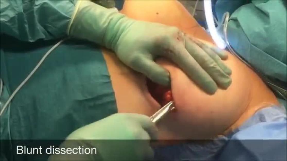Robotic Nipple-Sparing Mastectomy with Immediate Prosthetic Breast