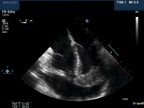 Intraoperative transesophageal echocardiogram