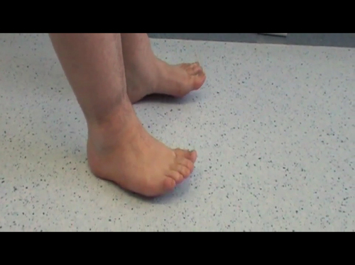 THE ANTERIOR TIBIALIS TENDON RE-ROUTING TECHNIQUE: CLINICAL RESULT 2
