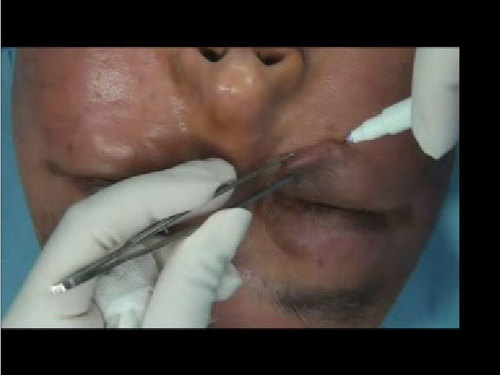 Video of eyelid surgery