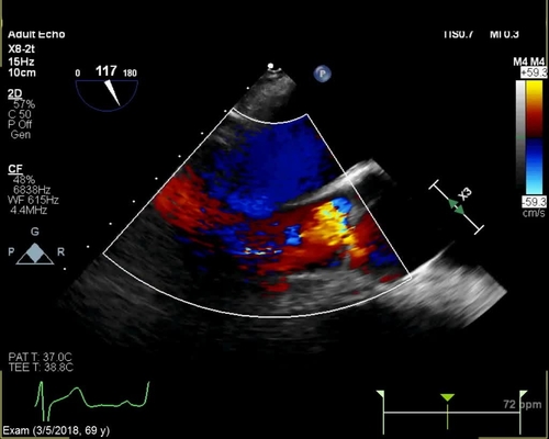 Endocarditis: aortic insufficiency with color flow