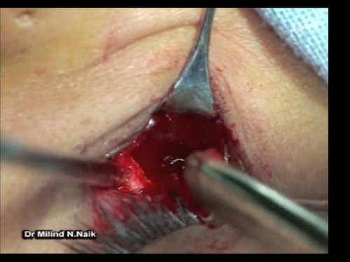 Subciliary Incision for External Dacryocystorhinostomy