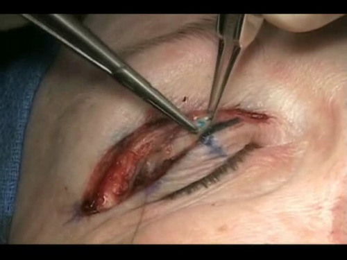 Eyelid deals surgery video