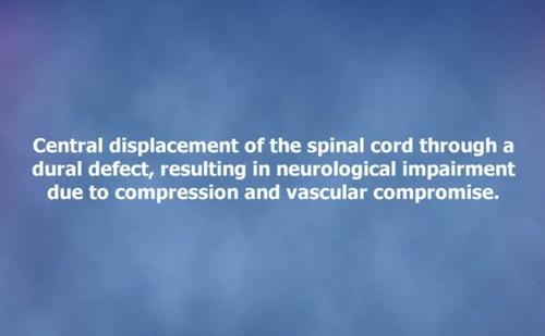Surgical Treatment of Thoracic Spinal Cord Herniation