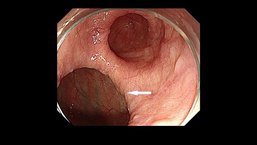 Magnet-assisted diverticuloplasty in the treatment of a large epiphrenic esophageal diverticulum