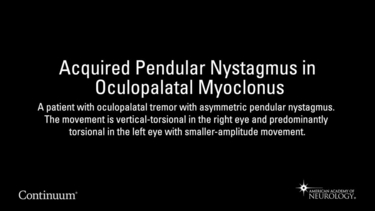 Acquired Pendular Nystagmus in Oculopalatal Myoclonus