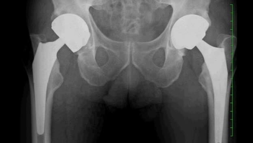 Direct Anterior Approach for Revision Total Hip Arthroplasty: Anatomy and Surgical Technique