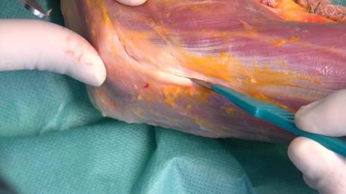 Kocher Approach or Kaplan Approach to the Lateral Elbow