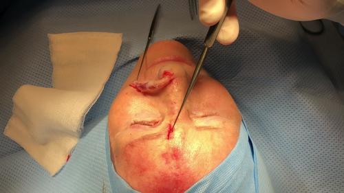 Corset trunkplasty (corset with scar) intraoperative images. (Above