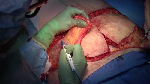 Simultaneous DIEP flap and LAP Flap 