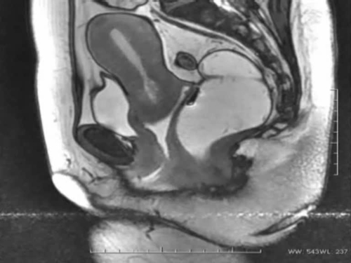 A minimally invasive technique for the one-stage treatment of complex pelvic floor diseases: Laparoscopic – Pelvic Organ Prolapse suspension (L- POPs) – Video 2
