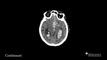 Admission head CT in a patient with subarachnoid hemorrhage.
