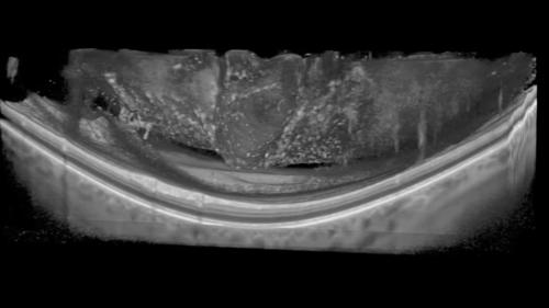 IMAGING THE VITREOUS WITH A NOVEL BOOSTED OPTICAL COHERENCE TOMOGRAPHY TECHNIQUE: Vitreous Degeneration and Cisterns (Video 2)