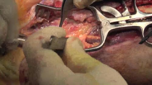 Compartment Syndrome: Hand and Forearm Fasciotomy