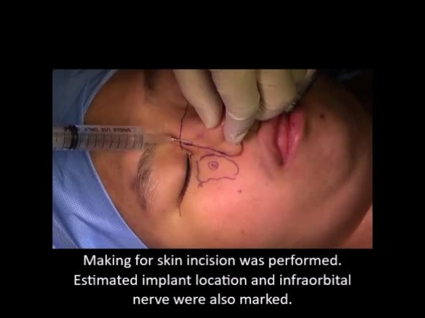 Plastic and Reconstructive Surgery – Global Open