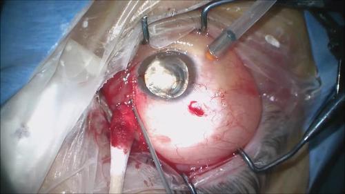 Repairing Leaky 23 Gauge Sclerotomies: Surgical Techniques to Enhance Sutureless Self-Sealing Wound Closure (Video 2)