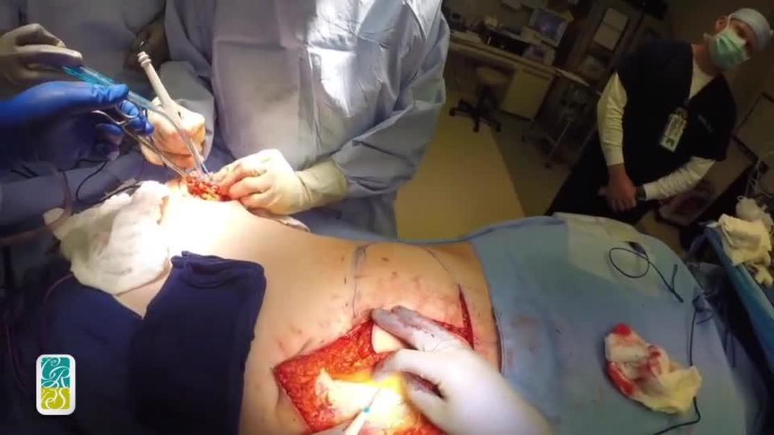 APEX Flap vs. DIEP Flap Reconstruction: Is There a Difference?