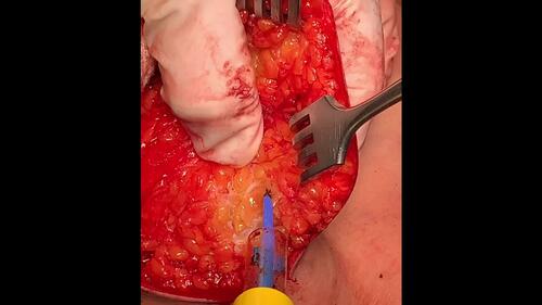 Mastectomy Dissection. Video from “Direct-to-Implant, Prepectroal Breast Reconstruction: Geometric Breast Measurements and Changes at 2-Years of Follow-Up.” 151(6).