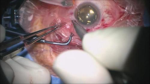 Repairing Leaky 23 Gauge Sclerotomies: Surgical Techniques to Enhance Sutureless Self-Sealing Wound Closure (Video 1)