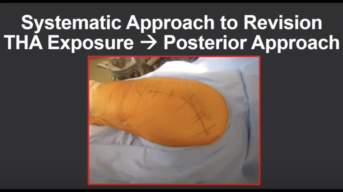 JAAOS - Journal of the American Academy of Orthopaedic Surgeons
