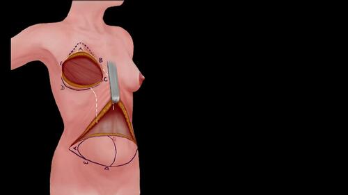 Raising the Abdominal Flap – Step I. Video 3 from “A Safe and Efficient Technique for Pedicled TRAM Flap Breast Reconstruction” June 2023 – 151 (6) CME