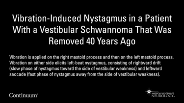 Vibration-induced nystagmus in a patient with a vestibular schwannoma that was removed 40 years ago