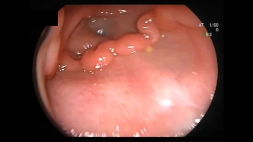 Gastrointestinal bleeding in a child: is it a Meckel's diverticulum?