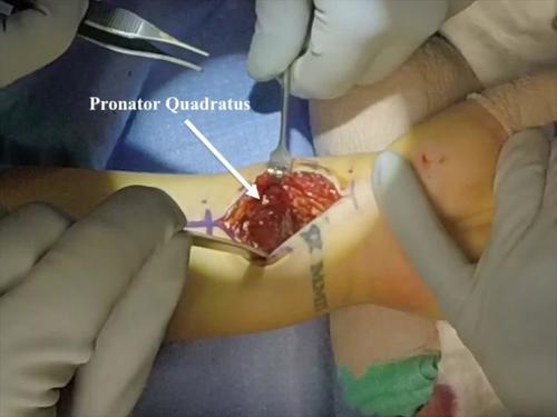 Use of Volar Plate for indirect Coronal Plane Reduction in an Intraarticular Distal Radius Fracture