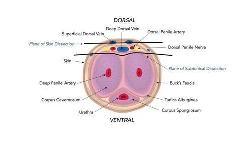 Variations in Technique for Harvest of Neo-clitoral Flap  Video from “Gender-Affirming Vaginoplasty: A Comparison of Algorithms, Surgical Techniques and Management Practices Across 17 High-Volume Centers In North America and Europe.”