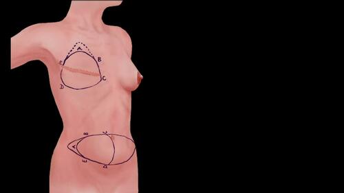 Pre-Operative Markings. Video 1 from “A Safe and Efficient Technique for Pedicled TRAM Flap Breast Reconstruction” June 2023 – 151 (6) CME