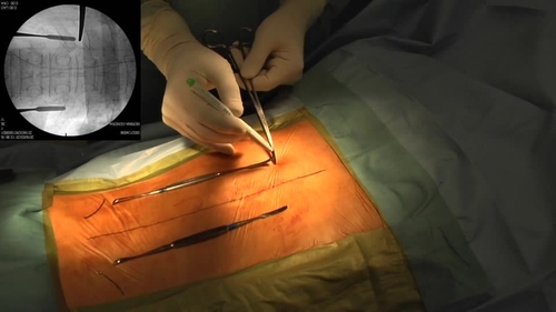 A Novel Groove-Entry Technique for Inserting Thoracic Percutaneous Pedicle Screws