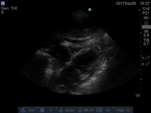 POC ultrasound shock--video 7