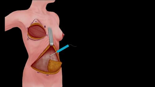 Raising the Abdominal Flap – Step II. Video 4 from “A Safe and Efficient Technique for Pedicled TRAM Flap Breast Reconstruction” June 2023 – 151 (6) CME