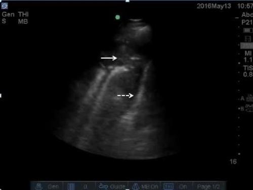 POC ultrasound shock--video 10